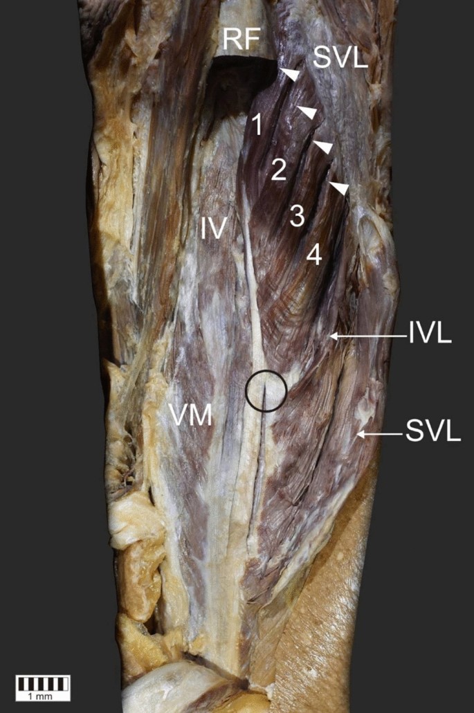 The Fifth Head Of Quadriceps Femoris For Sure Springerlink