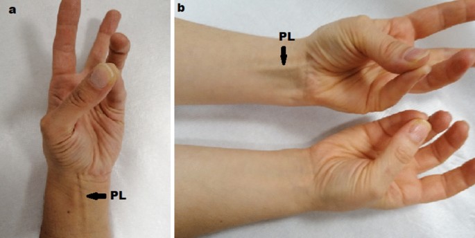 Determination of congenital absence of palmaris longus tendon with 