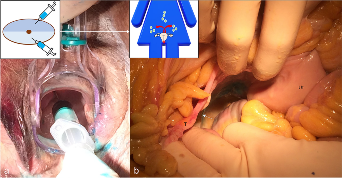 The lymphatic system of the uterine cervix: towards a more precise 