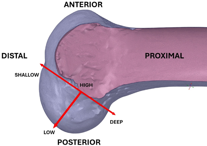 Intercondyler Ridge The forgotten third: understanding the ACL femoral insertion and ...
