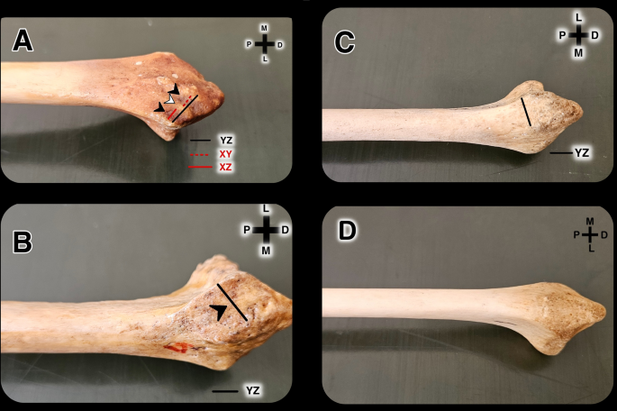 Osseous anatomy of the distal radius: a morphometric analysis of ...