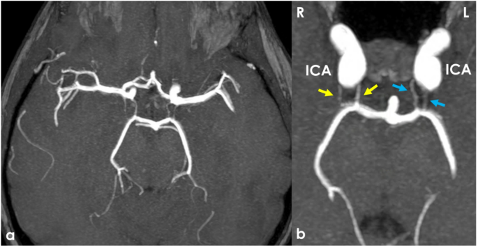 Pcom Radiology Bilateral duplication of the posterior communicating artery | Surgical ...