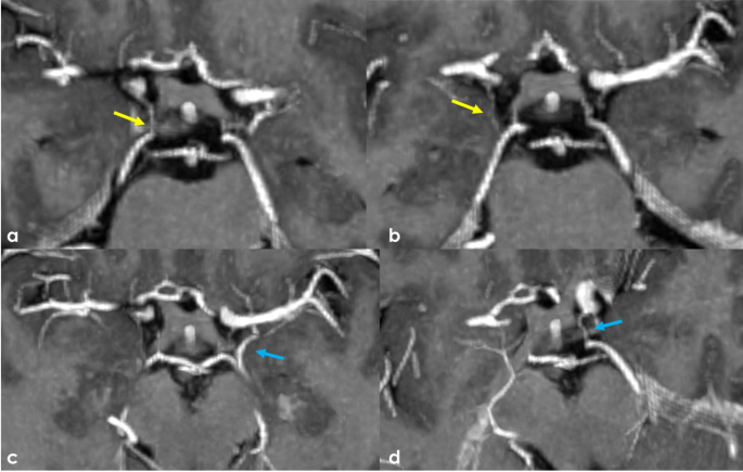 Bilateral duplication of the posterior communicating artery | Surgical ...