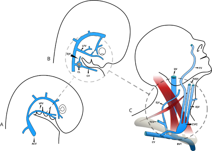 Unusual patterns of superficial venous drainage in the neck: a case ...