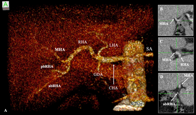 The anatomy and surgical implications of the middle hepatic artery: a ...