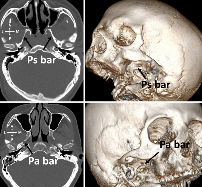 Ps Bar Location of the foramen ovale relative to the lateral pterygoid plate ...