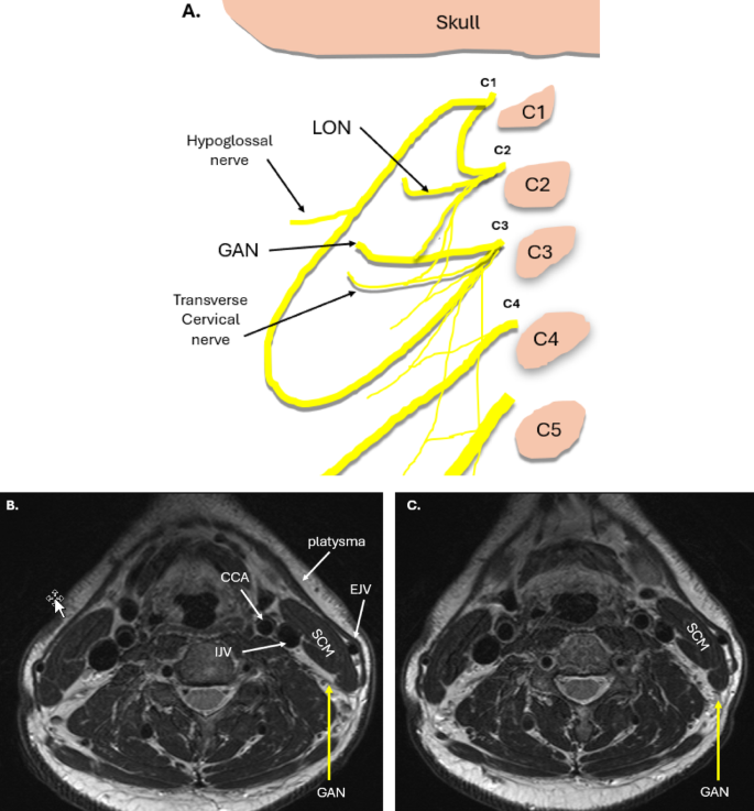 Sonographic anatomy and imaging of the great auricular nerve | Surgical ...