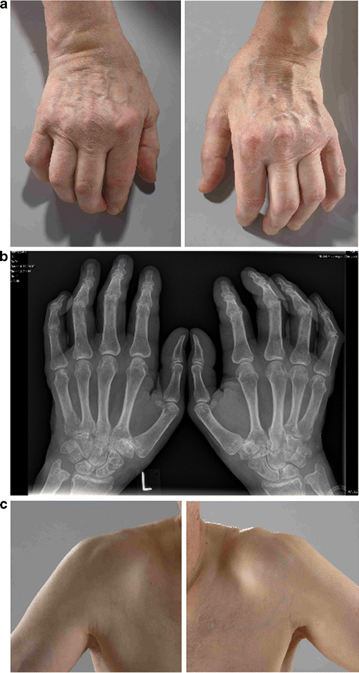 Atypical polyarthritis as a major manifestation of light chain disease |  SpringerLink