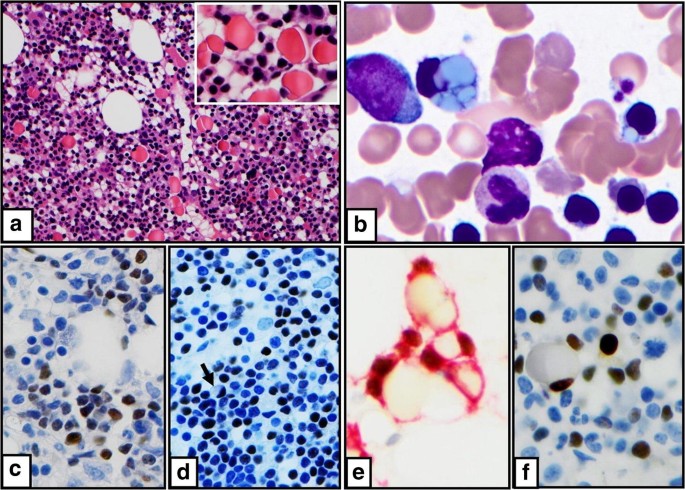 Chronic Lymphocytic Leukemia With Plasmacytic Differentiation Springerlink