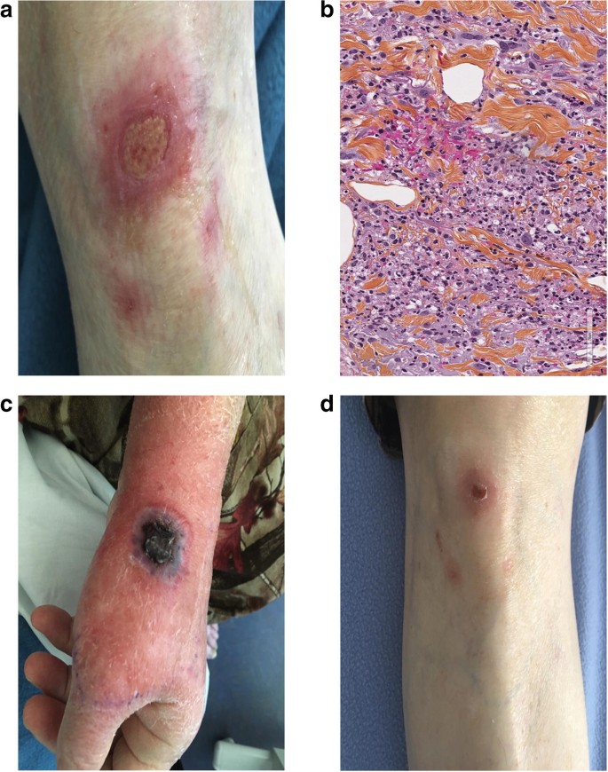 Pyoderma gangrenosum induced by lenalidomide in a case of multiple myeloma  | SpringerLink