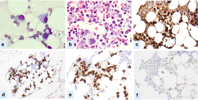 Plasmablastic IgM multiple myeloma with hypocellular bone marrow |  SpringerLink