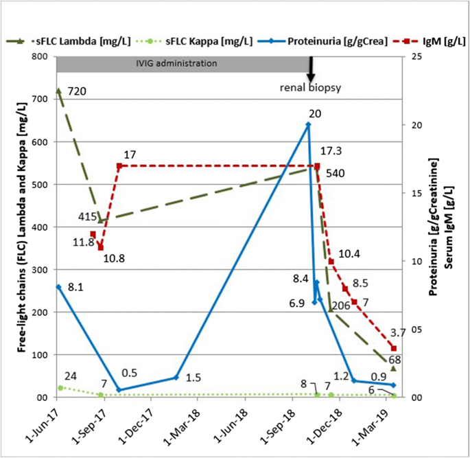 IgM-MGUS associated membranoproliferative during IVIG administration |