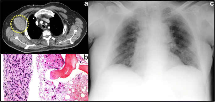 Fatal Sars Cov 2 Coinfection In Course Of Ebv Associated Lymphoproliferative Disease Springerlink