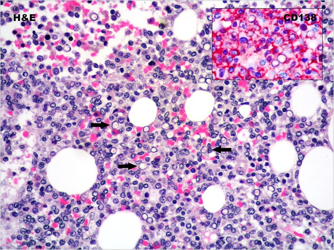 Dutcher bodies in IgA multiple myeloma | SpringerLink