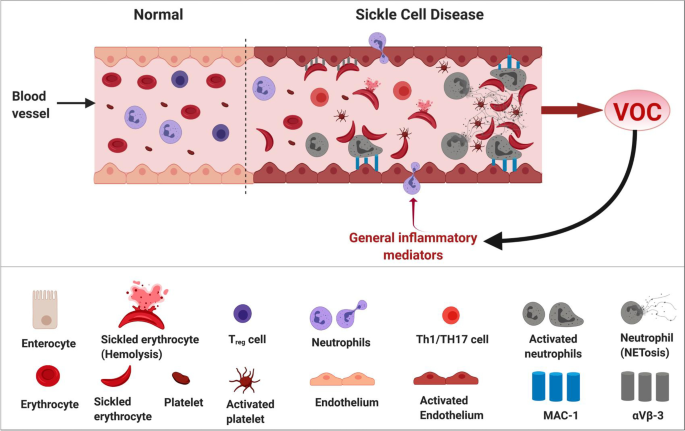 glutathione sickle cell disease L-glutamine for sickle cell disease: more than reducing redox | Annals of  Hematology