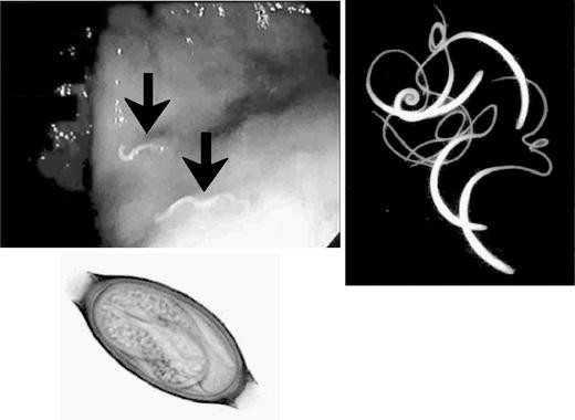 helminthiasis torok