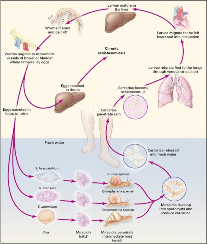 schistosomiasis pre sinusoidal