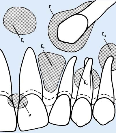 Benigne Epitheliale Odontogene Tumoren Springerlink