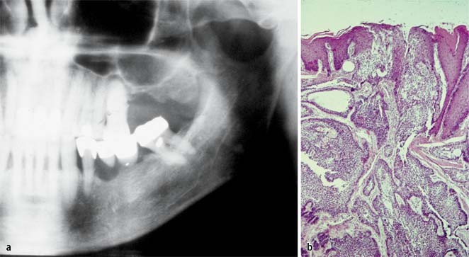 Benigne Epitheliale Odontogene Tumoren Springerlink