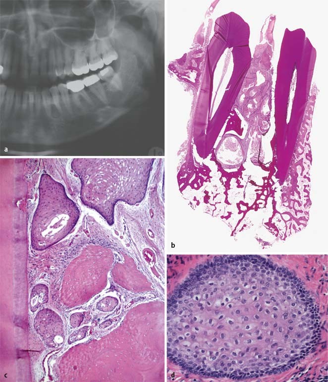 Benigne Epitheliale Odontogene Tumoren Springerlink