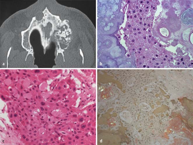 Benigne Epitheliale Odontogene Tumoren Springerlink