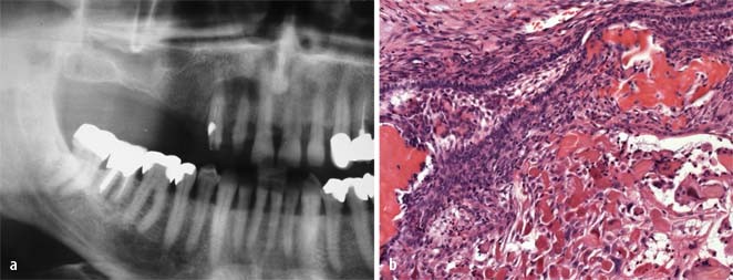 Benigne Gemischte Odontogene Tumoren Springerlink
