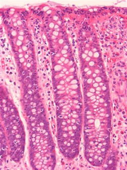 Histopathologie der mikroskopischen Kolitis | SpringerLink