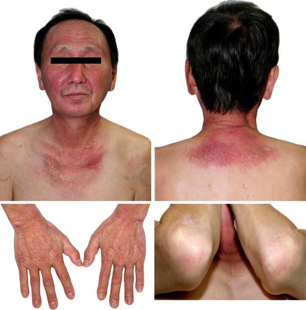 Dermatomyositis Associated With Hepatitis B Virus Related Hepatocellular Carcinoma Springerlink