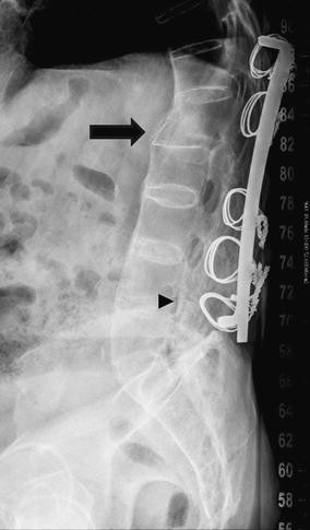 Cureus, Brainstem and Spinal Arachnoiditis Ossificans Associated With  Neurocysticercosis: A Case Report