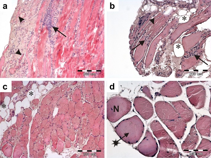 Immunohistochemical and ultrastructural analysis of sporadic inclusion body  myositis: a case series | SpringerLink