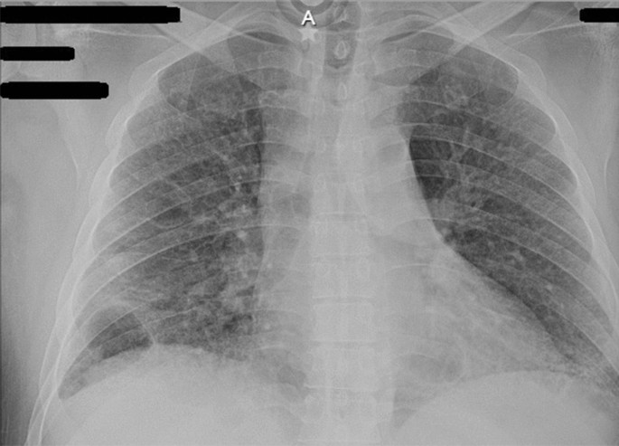 Can The Sars Cov 2 Infection Trigger Systemic Lupus Erythematosus A Case Based Review Springerlink