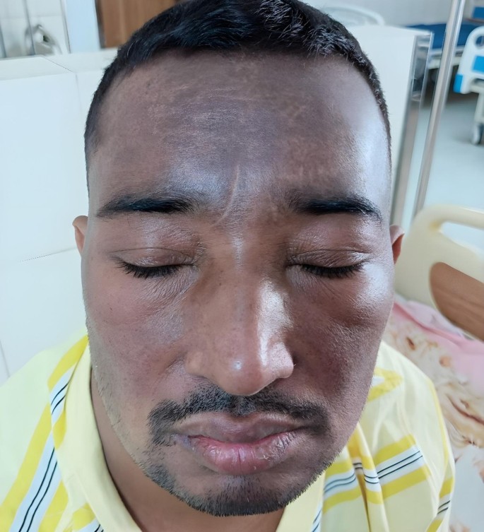 Ab Ignitis Rash Concomitant IgA nephropathy and dermatomyositis: a case-based review ...
