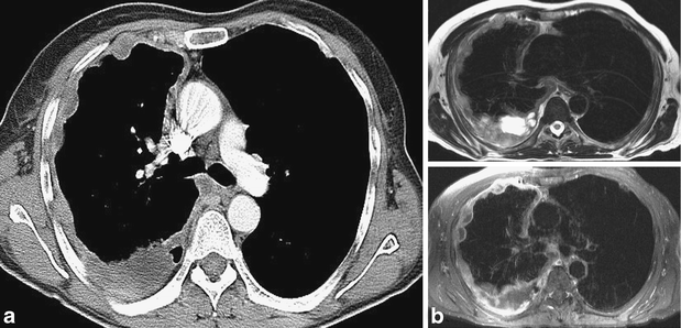 Prognostic significance of morphological growth patterns and mitotic index  of epithelioid malignant peritoneal mesothelioma - Krasinskas - 2016 -  Histopathology - Wiley Online Library