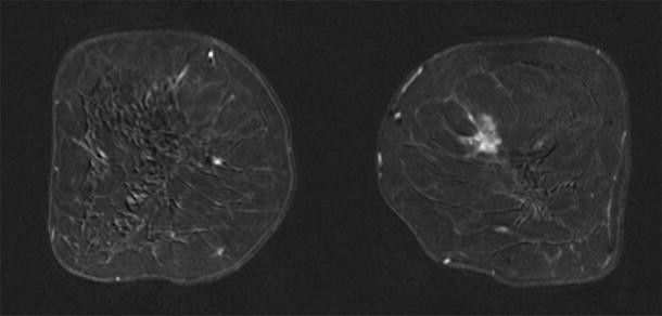 SciELO - Brasil - Breast imaging in patients with nipple discharge Breast  imaging in patients with nipple discharge