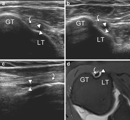 Detection and quantification of glenohumeral joint effusion ...