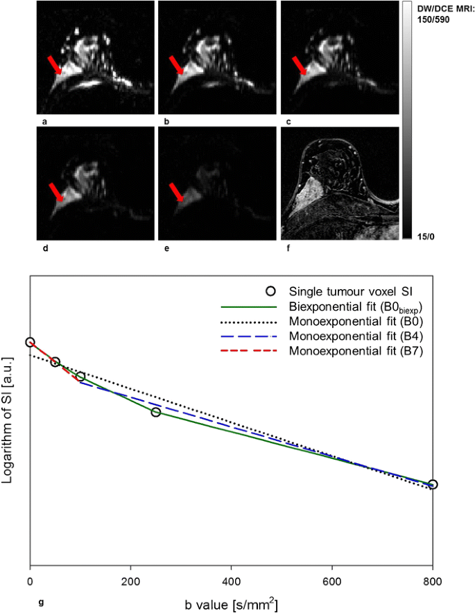 Comparison of SI with b value of 1000 s/mm2 in malignant and benign