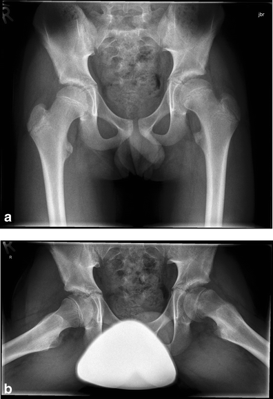 Painful paediatric hip: frog-leg lateral view only! | SpringerLink