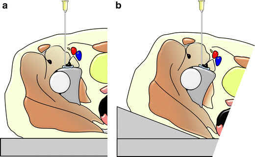 iliopsoas bursitis injection