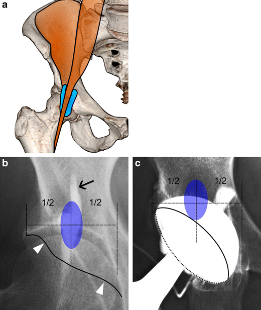 Stop Hip Bursitis Pain: Greater Trochanteric, Iliopsoas and Ischial Bursitis, Paperback