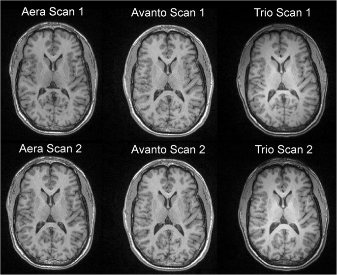 volumetrix example mri