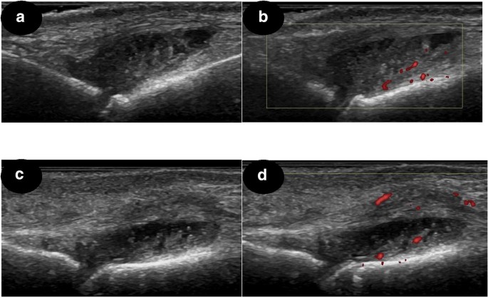 Real benefits of ultrasound evaluation of hand and foot synovitis for  better characterisation of the disease activity in rheumatoid arthritis |  European Radiology