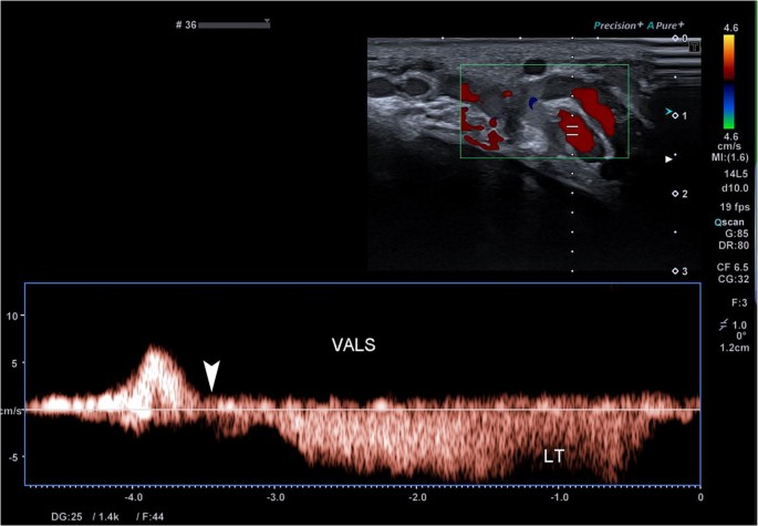 Intratesticular Varicocele Radiology Case Radiopaedia Org