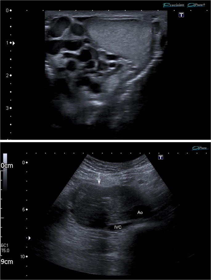 Testicular Varicoceles Radiology Key