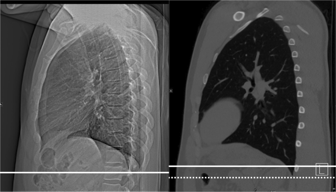 The relationship between CT scout landmarks and lung boundaries on chest  CT: guidelines for minimizing excess z-axis scan length | SpringerLink