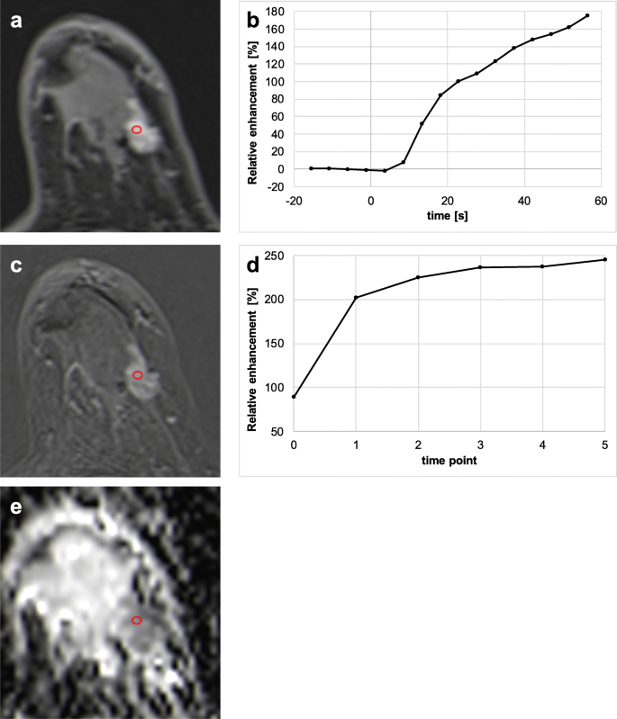 Combination of an ultrafast TWIST-VIBE Dixon sequence protocol and  diffusion-weighted imaging into an accurate easily applicable  classification tool for masses in breast MRI | SpringerLink