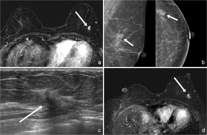 BI-RADS category 3, 4, and 5 lesions identified at preoperative breast MRI  in patients with breast cancer: implications for management | SpringerLink