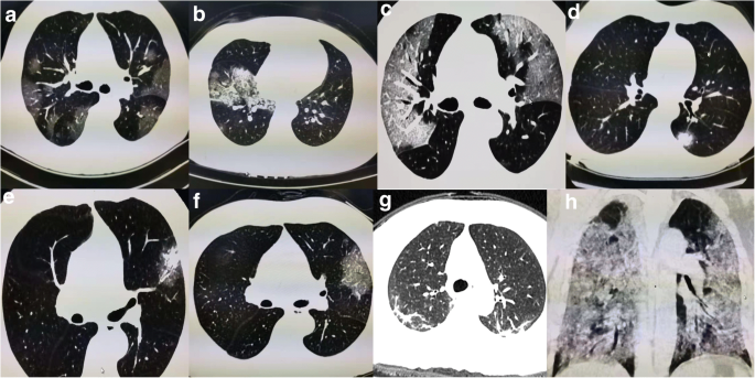 Imaging Changes In Patients With 2019 Ncov Springerlink