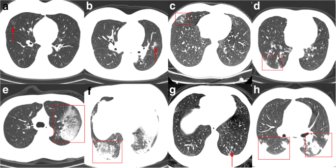 Initial Ct Findings And Temporal Changes In Patients With The Novel Coronavirus Pneumonia 19 Ncov A Study Of 63 Patients In Wuhan China Springerlink