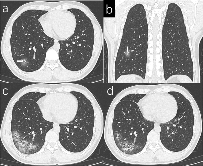 Chest Computed Tomography Findings Of Coronavirus Disease 19 Covid 19 Pneumonia Springerlink Chest Computed Tomography Findings Of Coronavirus Disease 19 Covid 19 Pneumonia Springerlink