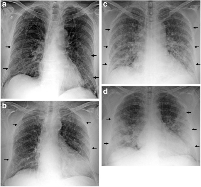 Radiographic Findings In 240 Patients With Covid 19 Pneumonia Time Dependence After The Onset Of Symptoms Springerlink